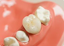 オールセラミック