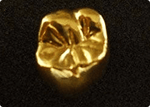 ゴールド (詰め物のみ)