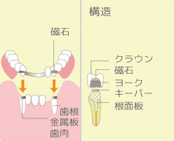 アタッチメント