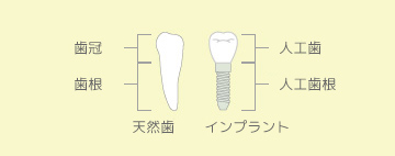 天然歯とインプラントの違い
