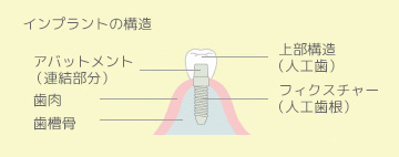 インプラントの構造