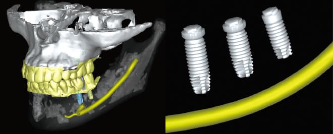 サージカルガイドを用いた安全・精確な手術