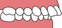 上顎前突/出っ歯