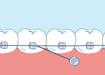 インプラント矯正