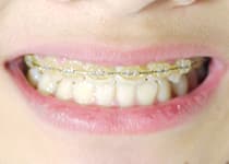 プラスチックブラケット