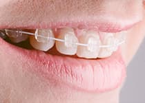 セラミックブラケット