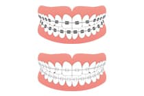 装置の作製・装着