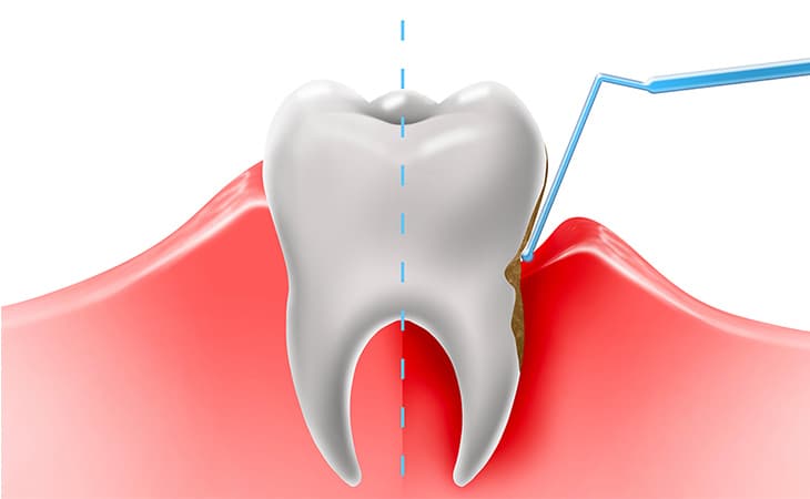 歯ぐきのセルフチェック