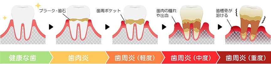 歯周病の進行