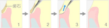 歯周ポケット掻爬術（新付着術）