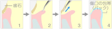 歯肉剥離掻爬術（フラップ手術）