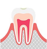むし歯の前兆