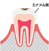 軽度のむし歯