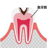 中度のむし歯