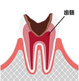 重度のむし歯