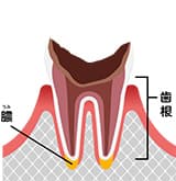 最重度のむし歯
