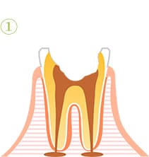 根管治療の流れ1
