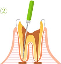 根管治療の流れ2