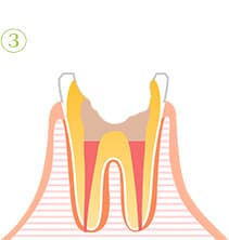 根管治療の流れ3