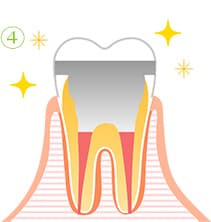 根管治療の流れ4