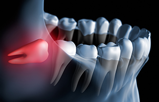親知らずの抜歯