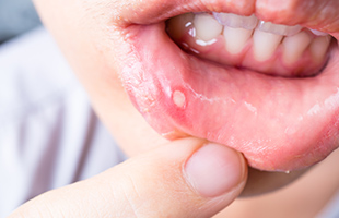 口内炎・できもの・膿など